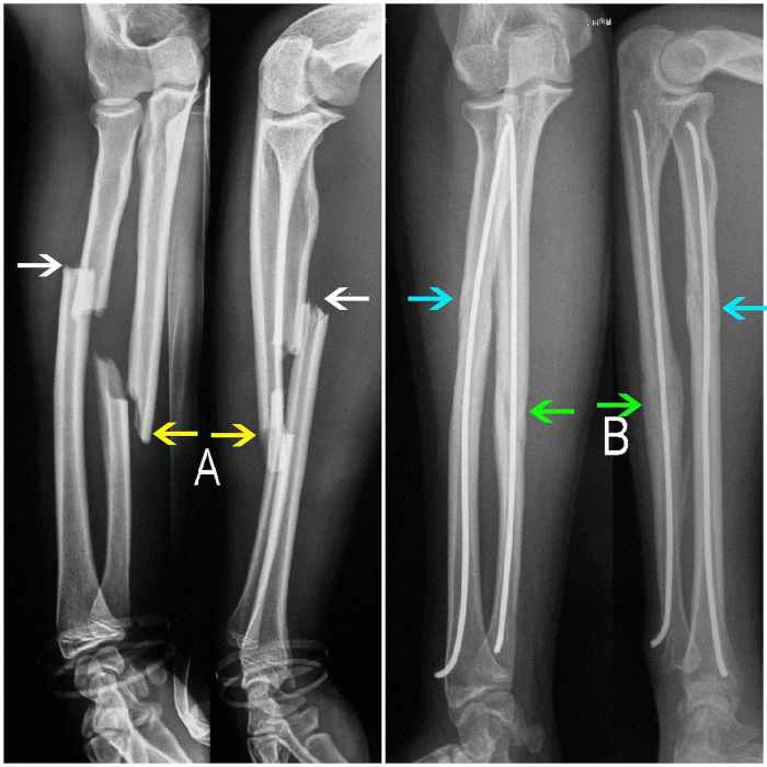 Radius and ulna bone quiz